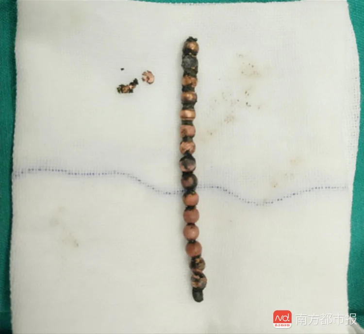 三岁男童反复腹痛呕吐!医生一查 体内竟有16颗磁铁!