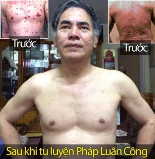 越战老兵讲述化学战后不可思议的经历
