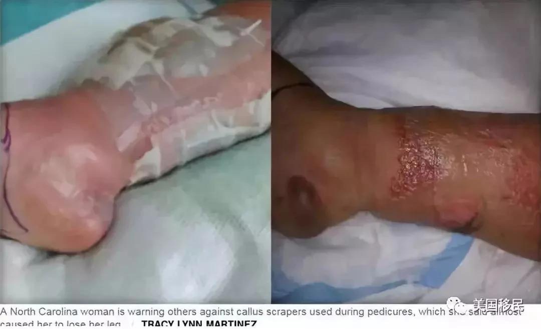 小傷口釀大禍! 美國女子磨腳皮細菌感染 險截肢