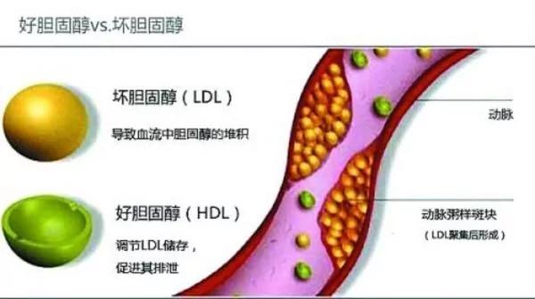 胆固醇过高就代表血管硬化?好坏胆固醇差在哪?医生教你看懂胆固醇数字真相