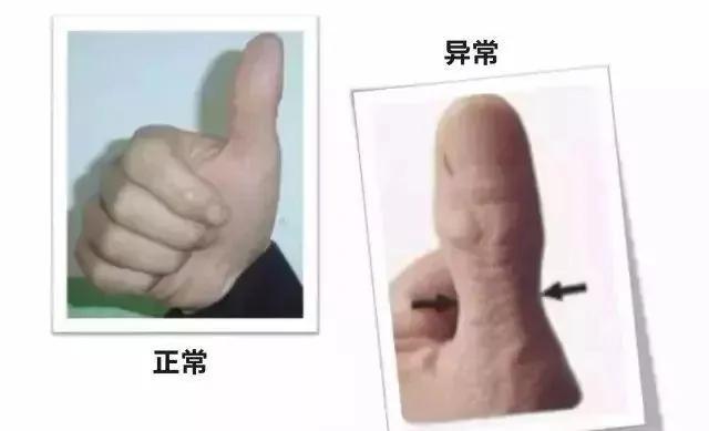 45岁之后 身体有这4个特征 说明你的肺部很健康