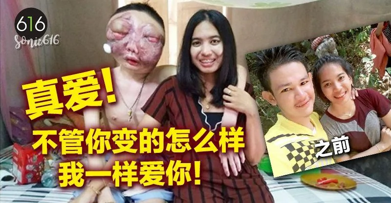 男子患癌脸部变形 女友伴3年不离不弃!