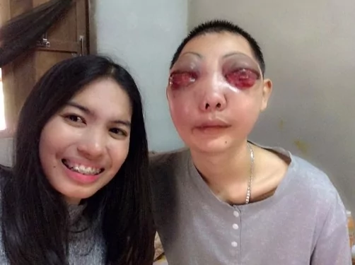 男子患癌脸部变形 女友伴3年不离不弃!