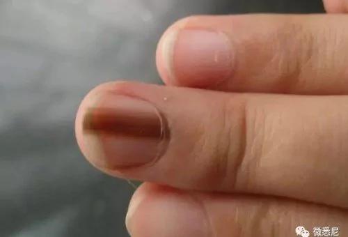 澳洲女子突然晒了张特写照 救了很多人