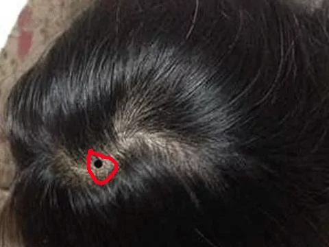 最常见的9大幸运痣!你有吗?