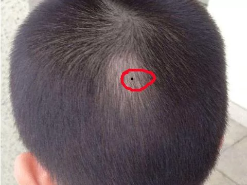 最常见的9大幸运痣!你有吗?