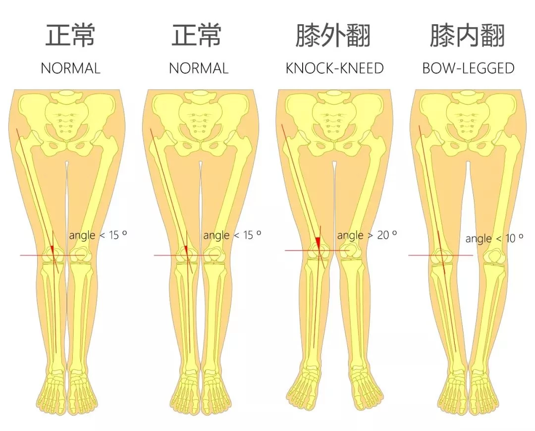 鞋底磨的偏左偏右 竟是疾病信号!快看你偏哪一边!