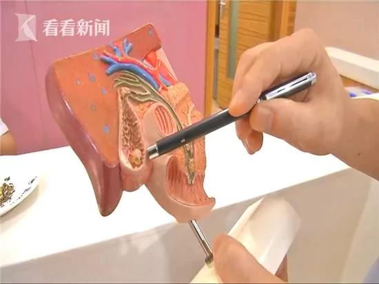 饮食不沾肉 六旬老人体内长55颗“爆米花”结石