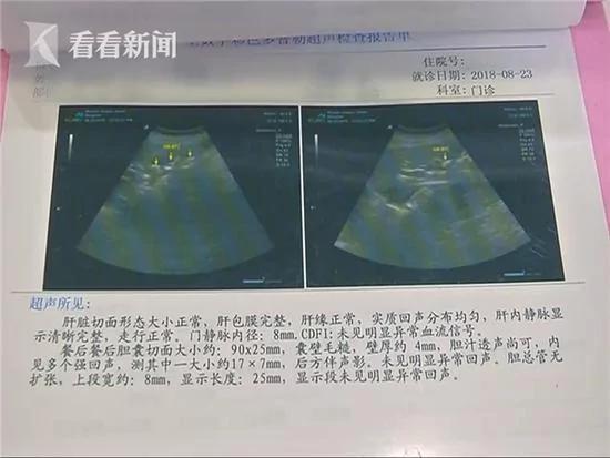 饮食不沾肉 六旬老人体内长55颗“爆米花”结石