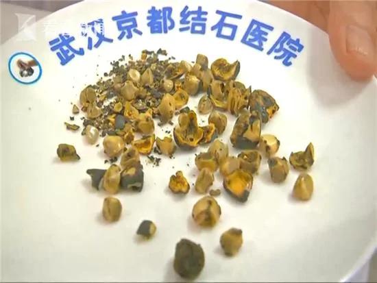 饮食不沾肉 六旬老人体内长55颗“爆米花”结石