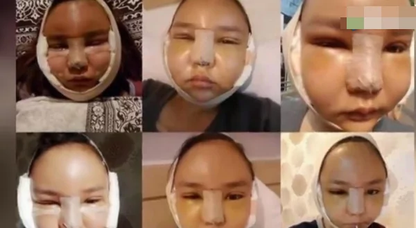 女子砸百万要整成杨幂 肿的成这样