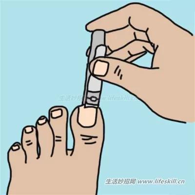 脚趾甲嵌进肉里了咋办?教你10个方法来解决