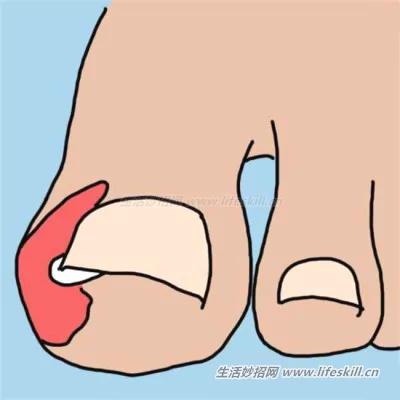 脚趾甲嵌进肉里了咋办?教你10个方法来解决