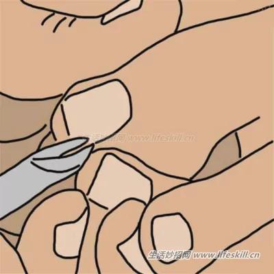 脚趾甲嵌进肉里了咋办?教你10个方法来解决