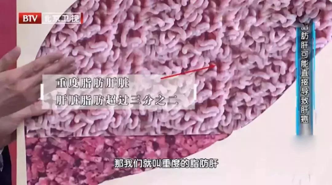 一份逆转脂肪肝的饮食原则!