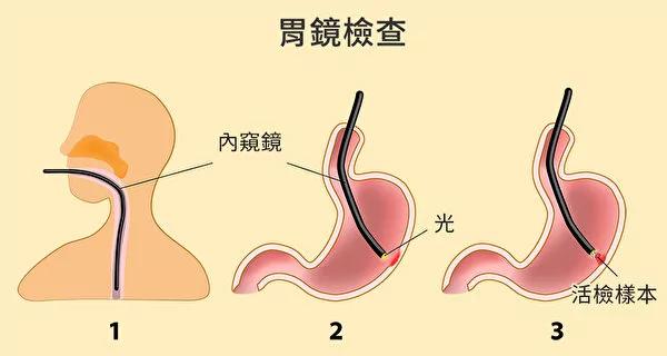 胃炎、胃息肉4种胃病可致癌!医师教你预防