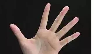 每天中指刮49下 刮走堵塞结节 中医教你全套【刮手操】