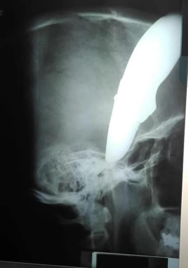 南非男子上班路上遇袭头部被插长刀,淡定骑车去医院就诊惊呆医生