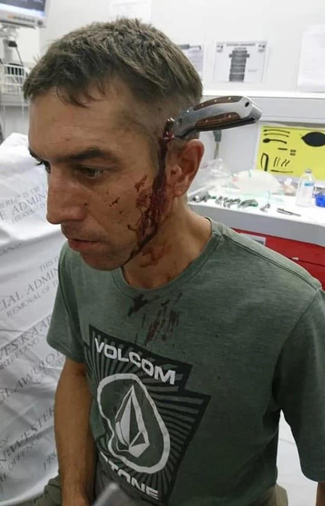 南非男子上班路上遇袭头部被插长刀,淡定骑车去医院就诊惊呆医生