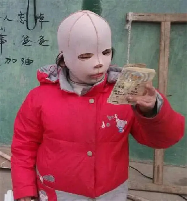 10歲小女孩整天帶着頭套同學都嘲笑她摘下面具後眾人淚奔 阿波羅新聞網