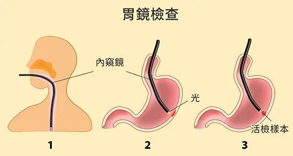 频繁腹胀腹痛 不可忽视的六大胃癌症状