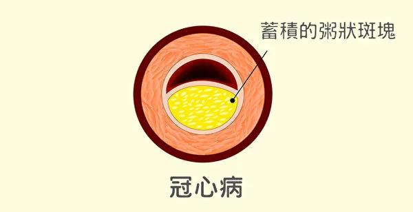 为什么会得心脏病?常见的心脏病和防治方法