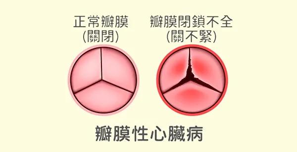 为什么会得心脏病?常见的心脏病和防治方法