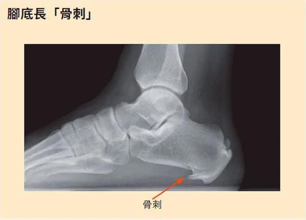 医生:足底筋膜炎速效缓解妙方竟是“这个”!