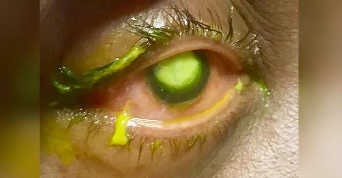 她戴隐眼睡觉 眼球变白「狂流萤光液体」…下场超恐怖!