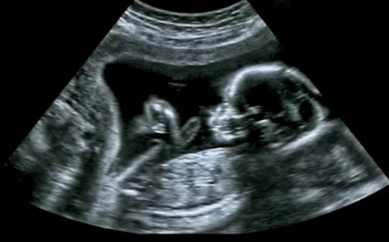 孕妇产检惊见婴儿狂吐舌头 孩子生下后却让她当场崩溃…