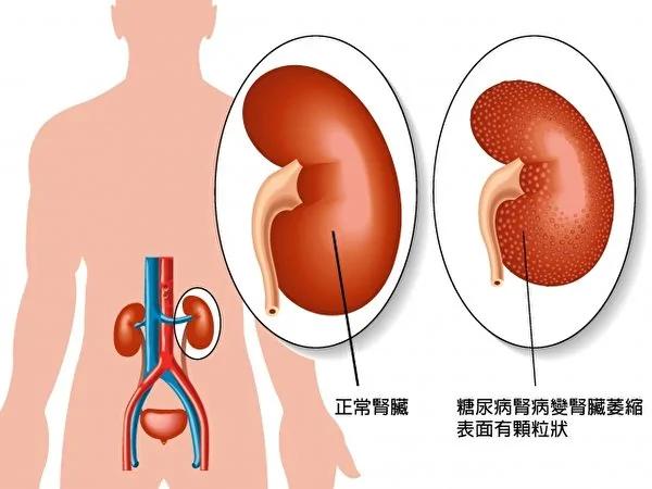 尿毒症一发现就是晚期 这3种病最好及时治