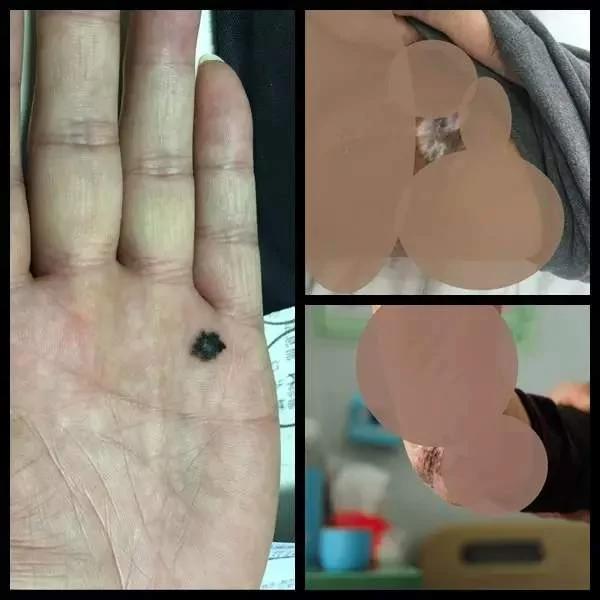 这些癌变都是手欠惹的祸!医生:身体这些部位长"痣"千万别抠!