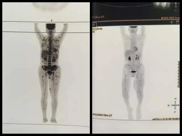 这些癌变都是手欠惹的祸!医生:身体这些部位长"痣"千万别抠!