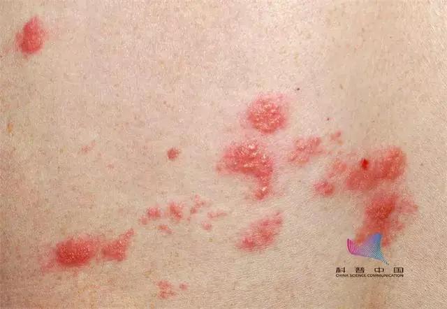 这种病毒竟能在身体里潜伏几十年!疼起来要命 如今终于有救了