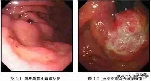 16个问题 弄清楚胃、十二指肠溃疡!