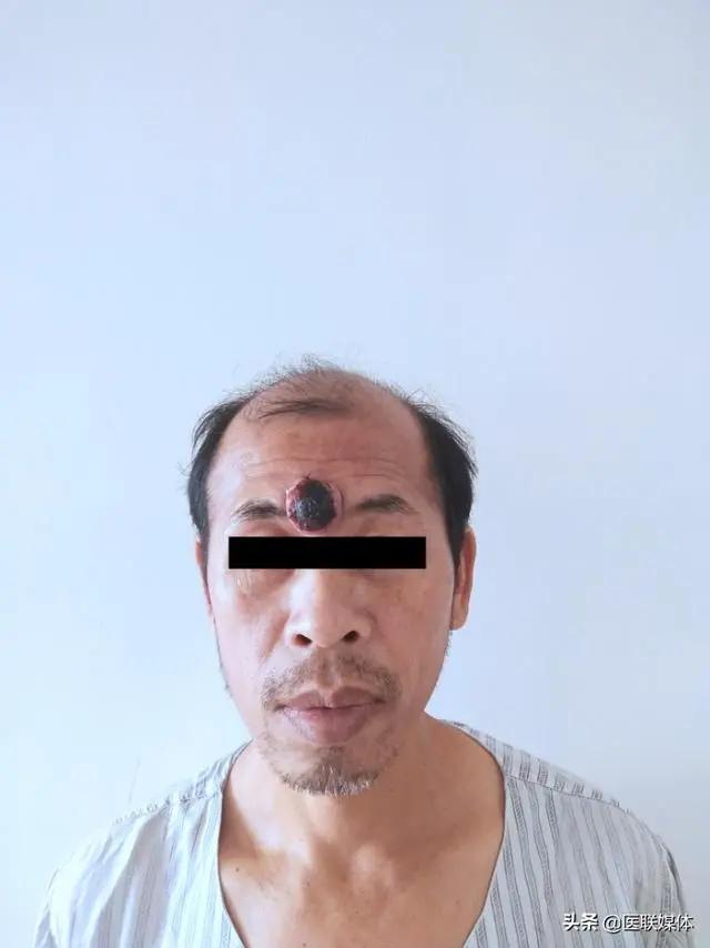 肿瘤“不走寻常路”:“米粒”变“天眼” 医生巧手“拆弹”