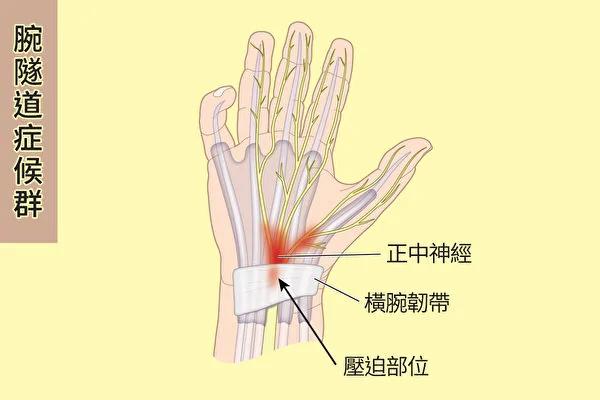 这种手麻小心腕隧道症候群!医师教你缓解