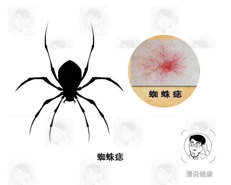 身体出现5个迹象 立即排查肝硬化!医生提醒:这3类人要特别注意
