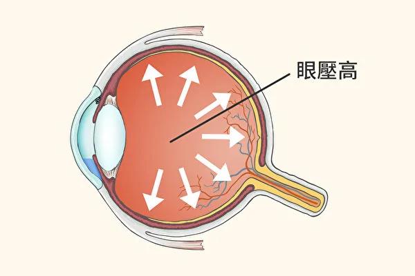 眼压高当心青光眼!医师教你这样做远离青光眼