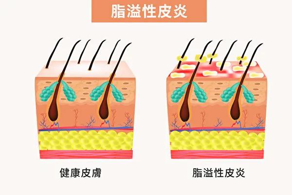 头皮和皮肤发痒脱屑?脂溢性皮炎爱找上3类人