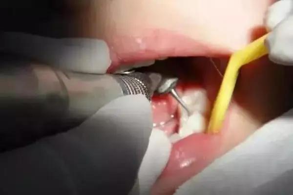 洗牙 是你看牙省钱的开始!