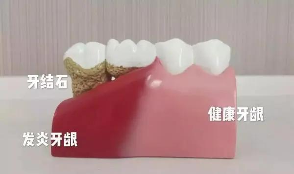 洗牙 是你看牙省钱的开始!