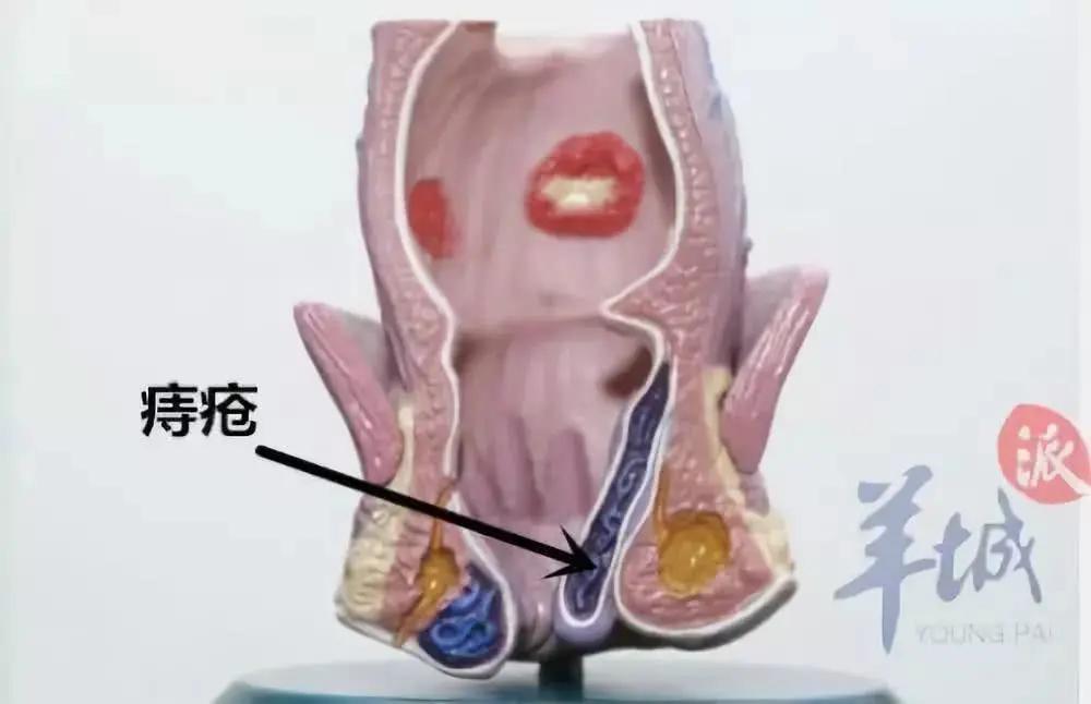不想做有“痔”青年?那就请如厕时放下手机!
