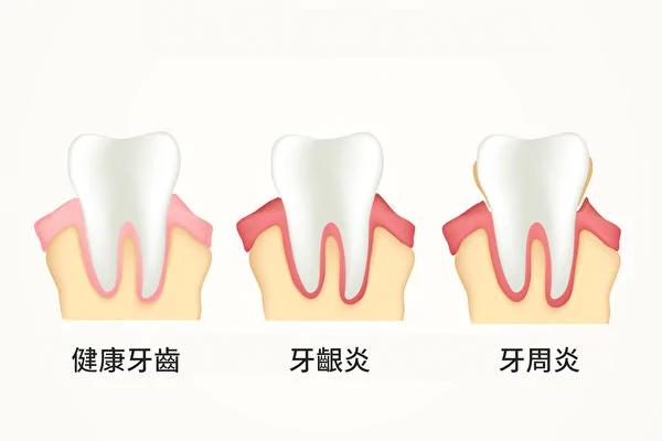 牙周病是身体慢性发炎?为体内灭火可防多种疾病