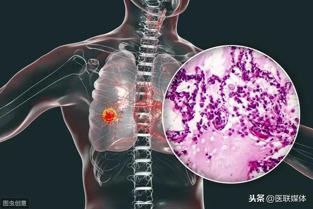 肺癌来临时 身体可能会有4个反应 可别以为很正常