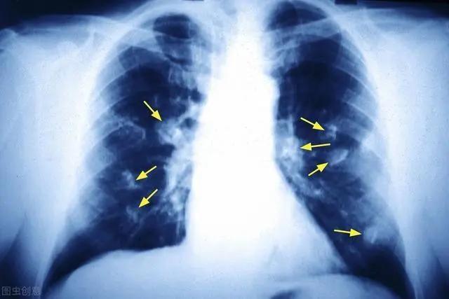 肺癌不只是咳嗽 皮膚有三個異常表現 注意儘早查查肺 莫忽視