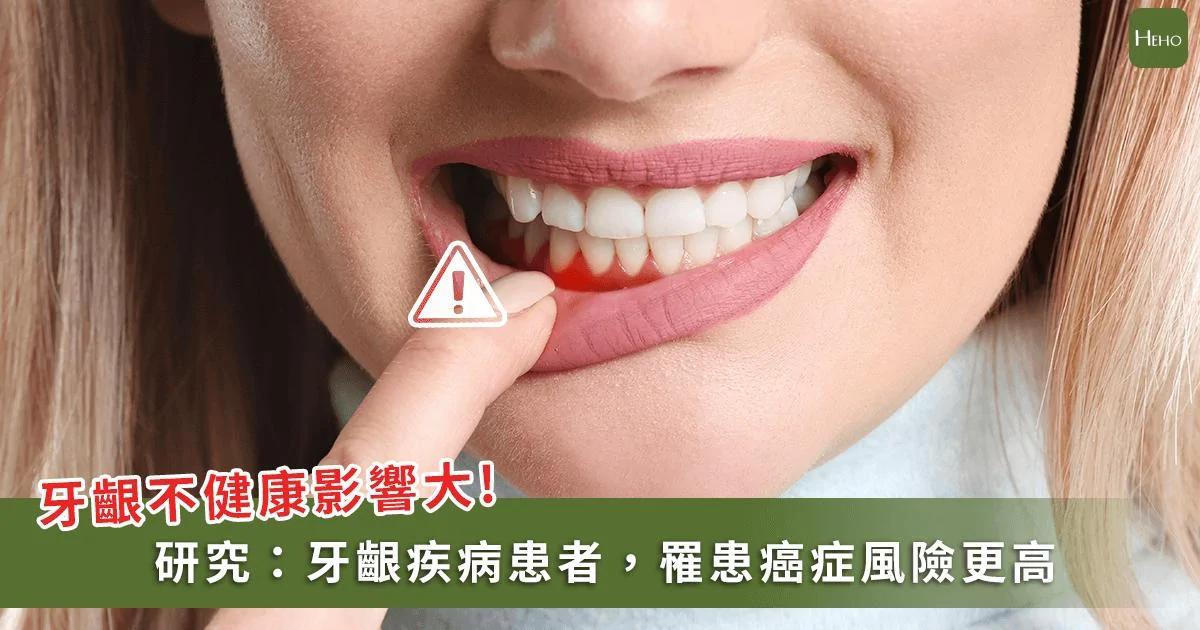 好好刷牙吧！權威期刊：牙周病讓胃癌、食道癌風險飆升50%