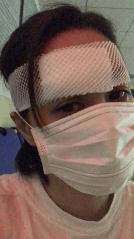 阿娇半夜晕眩自摔“头缝数十针”恐破相