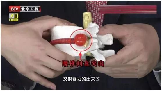 40歲後 超過一半的人有椎間盤膨出！5大傷腰習慣別再做 護腰竅門早掌握