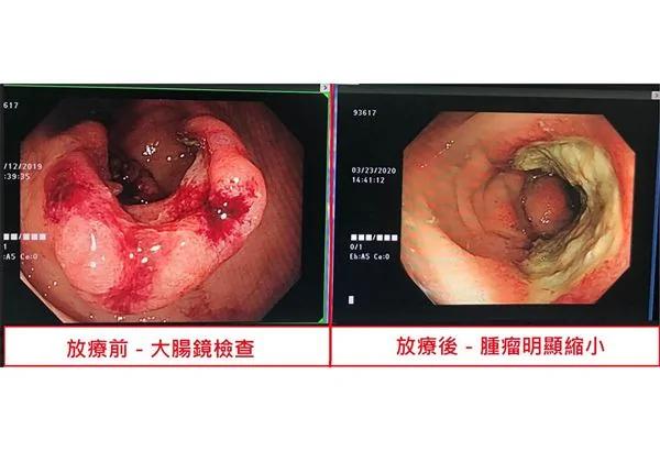 婦人嗜吃燒烤油炸食物 排血便長達4個月 知道患的什麼病嗎?真得注意了! 2 婦人嗜吃燒烤油炸食物 排血便長達4個月 知道患的什麼病嗎?真得注意了!